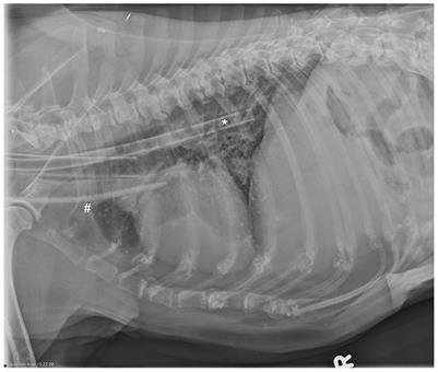 Case report: Chylopericardium secondary to dialysis catheter related jugular venous thrombosis in two dogs receiving long-term hemodialysis